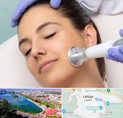 پلاسما جت در لاهیجان