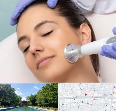 پلاسما جت در هشت بهشت اصفهان