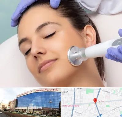 پلاسما جت در نصف راه تبریز