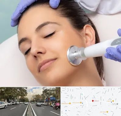 پلاسما جت در دولت