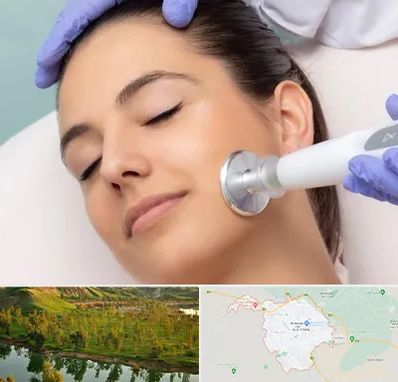 پلاسما جت در بهبهان