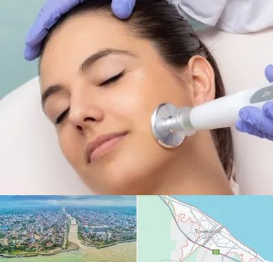 پلاسما جت در تنکابن