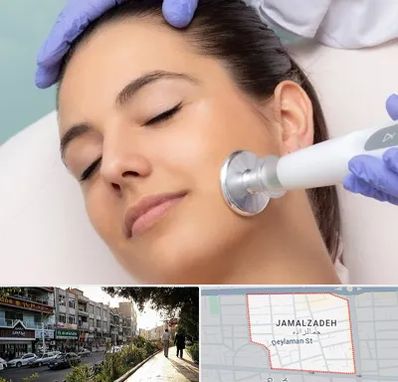 پلاسما جت در خیابان جمالزاده