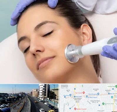 پلاسما جت در پیروزی