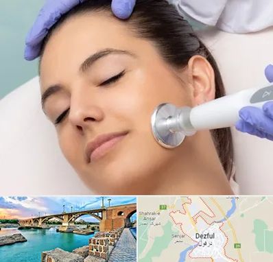 پلاسما جت در دزفول