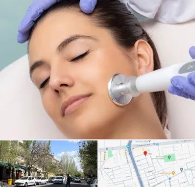 پلاسما جت در کوی فیروز تبریز