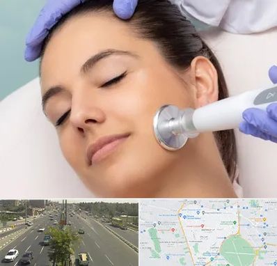 پلاسما جت در منطقه 17 تهران