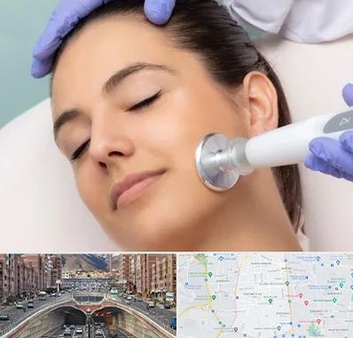 پلاسما جت در منطقه 10 تهران