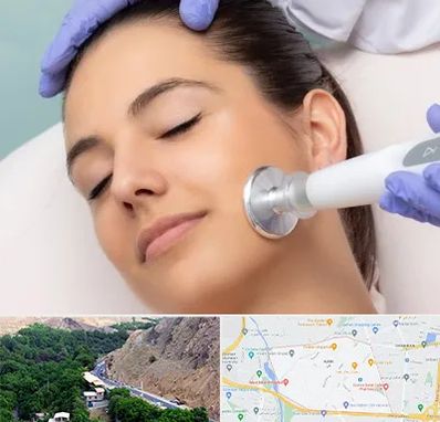 پلاسما جت در کن