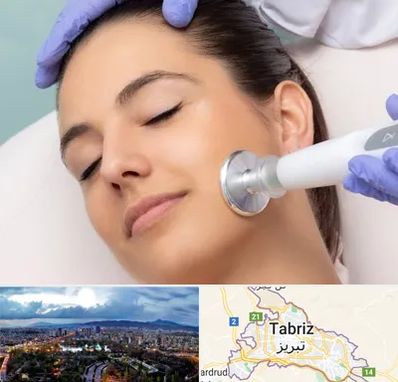 پلاسما جت در تبریز