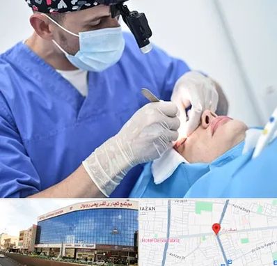 جراح سرطان چشم در نصف راه تبریز