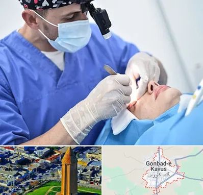 جراح سرطان چشم در گنبد کاووس