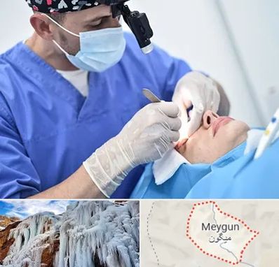 جراح سرطان چشم در میگون