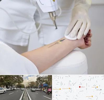 پاک کردن تتو با لیزر در دولت