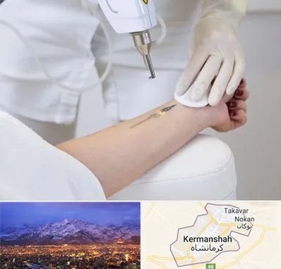 پاک کردن تتو با لیزر در کرمانشاه