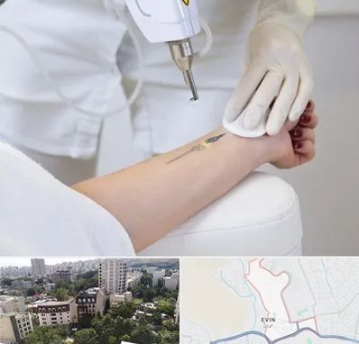 پاک کردن تتو با لیزر در اوین