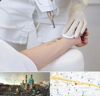 پاک کردن تتو با لیزر در رسالت