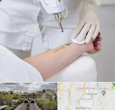 پاک کردن تتو با لیزر در یوسف آباد