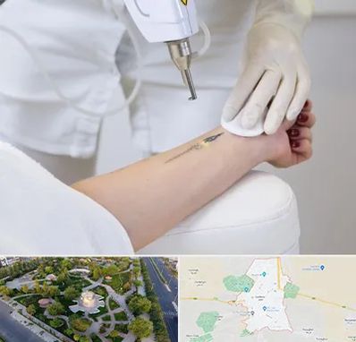 پاک کردن تتو با لیزر در کاشمر