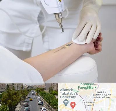 پاک کردن تتو با لیزر در شهران