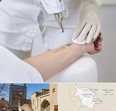 پاک کردن تتو با لیزر در تربت جام