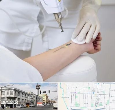 پاک کردن تتو با لیزر در 17شهریور