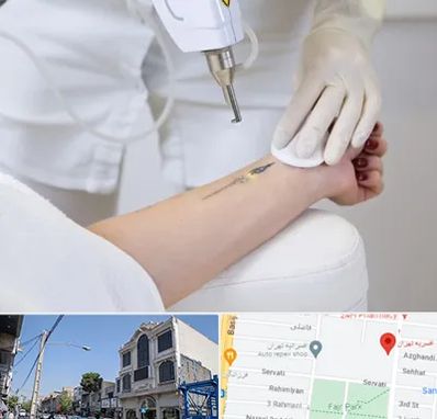 پاک کردن تتو با لیزر در افسریه