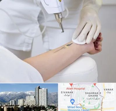 پاک کردن تتو با لیزر در شهرک غرب تهران