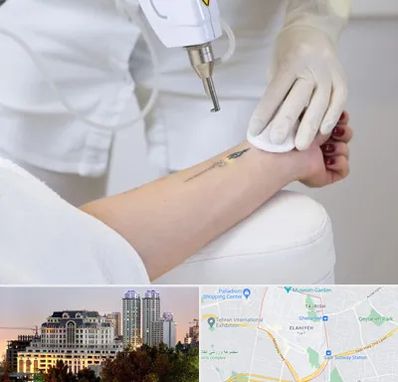 پاک کردن تتو با لیزر در فرشته