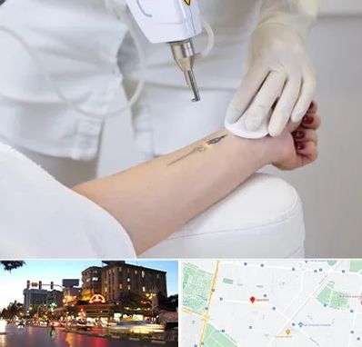 پاک کردن تتو با لیزر در بلوار سجاد مشهد