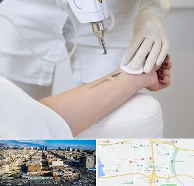 پاک کردن تتو با لیزر در شهرک راه آهن