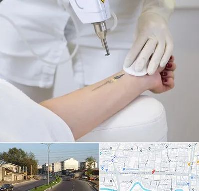 پاک کردن تتو با لیزر در ضیابری رشت