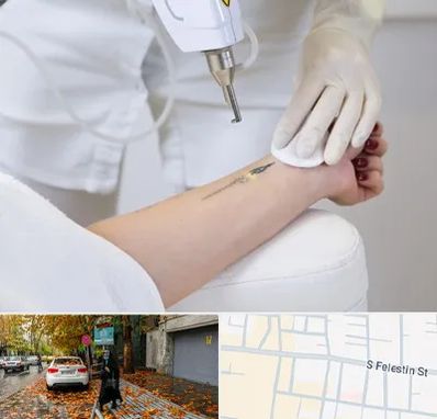 پاک کردن تتو با لیزر در خیابان فلسطین