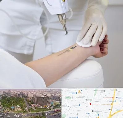 پاک کردن تتو با لیزر در آیت الله کاشانی