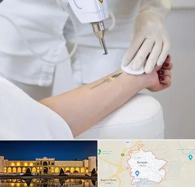 پاک کردن تتو با لیزر در برازجان