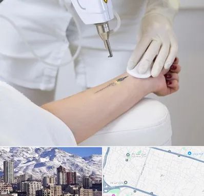 پاک کردن تتو با لیزر در ازگل