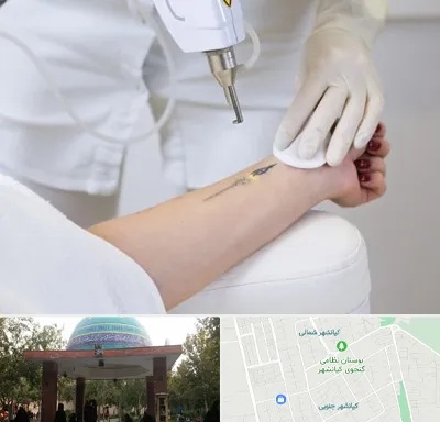 پاک کردن تتو با لیزر در کیانشهر