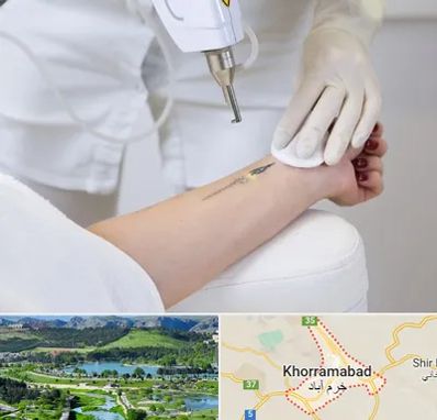 پاک کردن تتو با لیزر در خرم آباد