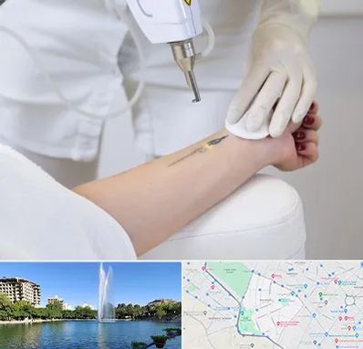 پاک کردن تتو با لیزر در کوهسنگی مشهد