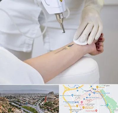 پاک کردن تتو با لیزر در معالی آباد شیراز