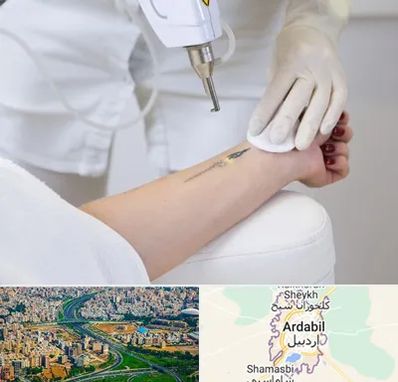 پاک کردن تتو با لیزر در اردبیل