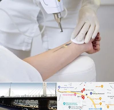 پاک کردن تتو با لیزر در پارک وی