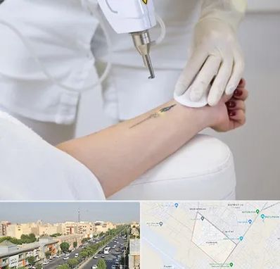 پاک کردن تتو با لیزر در کیانمهر کرج