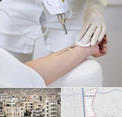 پاک کردن تتو با لیزر در اسکندری