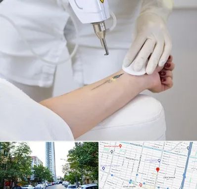 پاک کردن تتو با لیزر در امامت مشهد