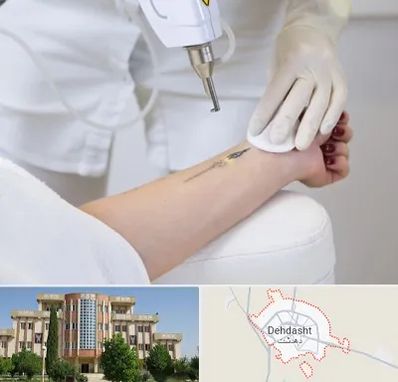 پاک کردن تتو با لیزر در دهدشت