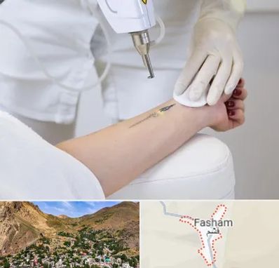 پاک کردن تتو با لیزر در فشم