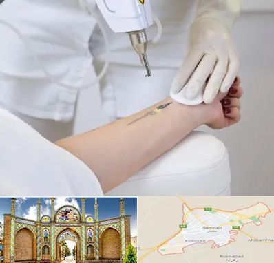 پاک کردن تتو با لیزر در سمنان