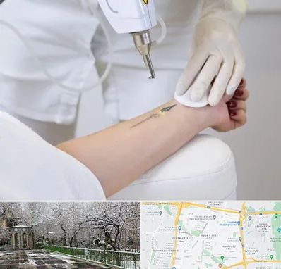 پاک کردن تتو با لیزر در باغ فیض