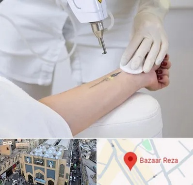 پاک کردن تتو با لیزر در بازار رضا مشهد